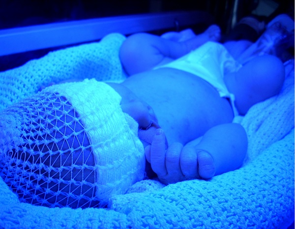 Как лечить повышенный билирубин у новорожденного