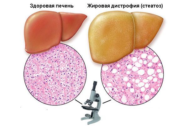 Степени жирового гепатоза