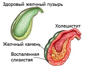 Бескаменный холецистит